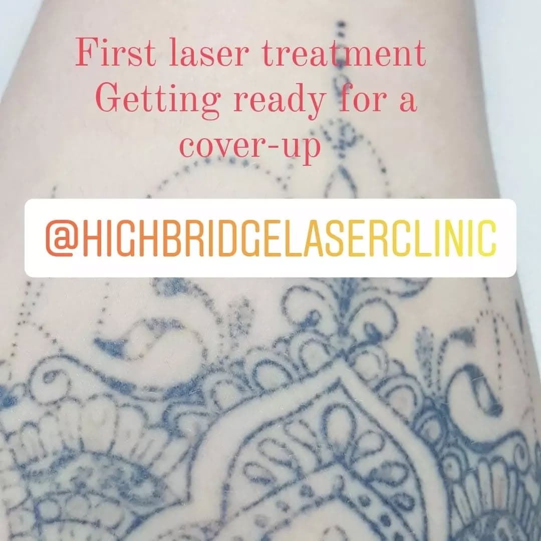 Cover-up all finished after laser treatment. 
#tattooremoval #tattoo #lasertattooremoval #laser #tattoos #laserhairremoval #skincare #beauty #tattooremovalspecialists #permanentmakeup  #tattooregret #skin #tattooremover #laserremoval #ink #eyebrows #hairremoval #laserclinic #ombrebrows #removaltattoo#coverup #inked #lasertattoo