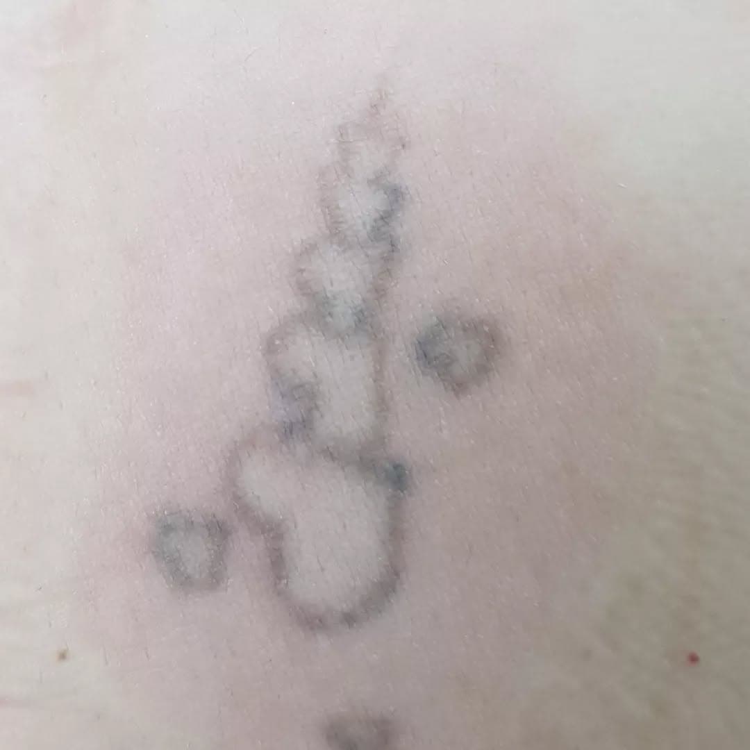 Fading really well just after second session. 
#tattooremoval #tattoo #lasertattooremoval #laser #tattoos #laserhairremoval #skincare #beauty #tattooremovalspecialists #permanentmakeup  #tattooregret #skin #tattooremover #laserremoval #ink #eyebrows #hairremoval #laserclinic #ombrebrows #removaltattoo#coverup #inked #lasertattoo