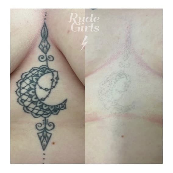 Healed after 9 sessions.
We can this tattoo see further down the grid after 7 sessions and there is a clear steady fade with parts of the bottom and top of the design now completely gone ⚡️

.
.
.
.
#rudegirlslaser #rudeboystudios #norwich #norwichbusiness #norwichlife #norwichgram #norwichlaser #norwichtattooremoval #norwichlaserremoval #norwichlaserclinic #norwichbusinessnetwork #norwichbusinesswomen #norwichbusinesses #norwichsmallbusiness #tattooremoval #lasertattooremoval #tattooremovalexperts #tattooremovalspecialists #tattooremovalspecialist #tattooremovallaser #tattooremovalmachine #tattooremovalclinic #tattooremovalprogress
#aw3 #allwhitelaser #aw3laser #aw3lasers