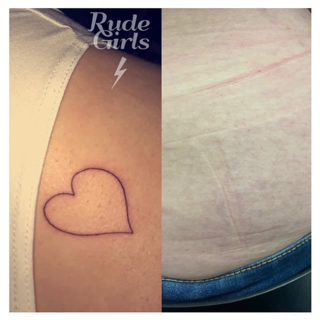 And that’s a wrap! This tattoo has been removed after 9 sessions 💪🏻⚡️

.
.
.
.
#rudegirlslaser #rudeboystudios #norwich #norwichbusiness #norwichlife #norwichgram #norwichlaser #norwichtattooremoval #norwichlaserremoval #norwichlaserclinic #norwichbusinessnetwork #norwichbusinesswomen #norwichbusinesses #norwichsmallbusiness #tattooremoval #lasertattooremoval #tattooremovalexperts #tattooremovalspecialists #tattooremovalspecialist #tattooremovallaser #tattooremovalmachine #tattooremovalclinic #tattooremovalprogress
#aw3 #allwhitelaser #aw3laser #aw3lasers