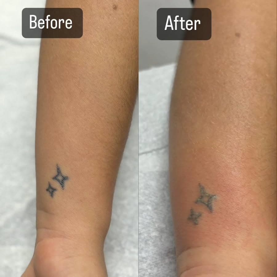 Laser tattoo removal please call or dm me for more info