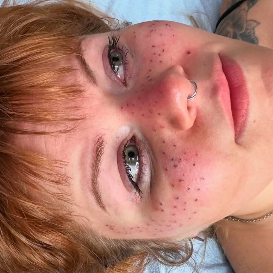 Freckles! Fresh—->Healed ✨ message Kylie @prettyinink513 for yours!