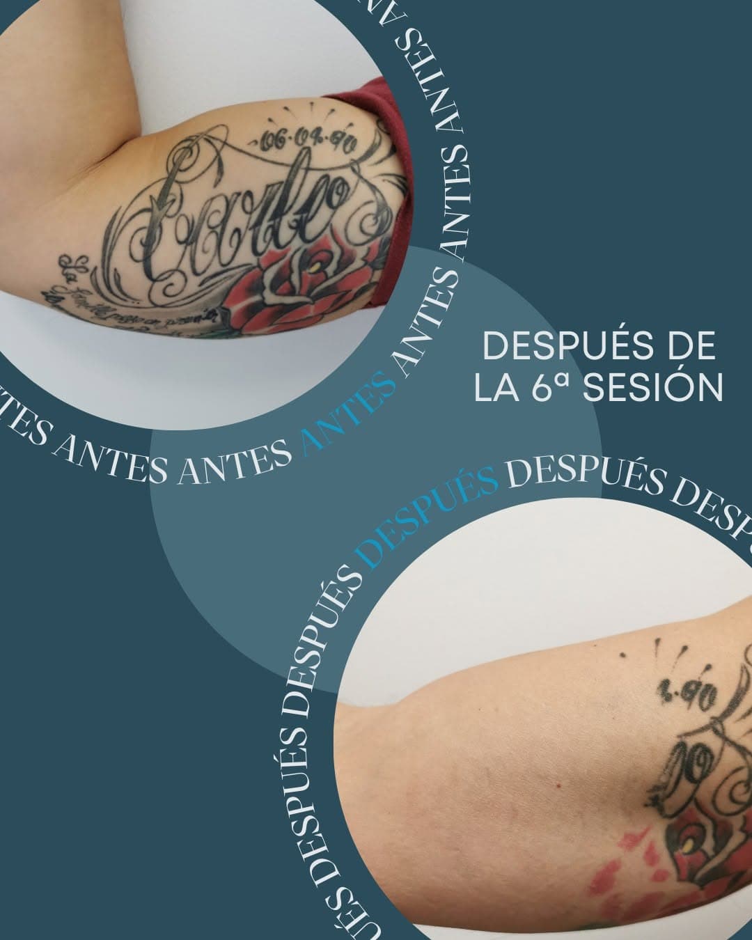 Nosotros también estamos sin palabras con este cambio 😶

Así te puedes hacer una idea de lo que podemos lograr en @nomastattoo en solo 6 sesiones... para lucir bíceps y tríceps sin rastro de tinta 🖋️

¿Tú también quieres empezar de cero? 💥

#NoMasTattoo #tatuajes #tattoo #GranCanaria #LasPalmas #eliminaciontatuajes #tattooremoval