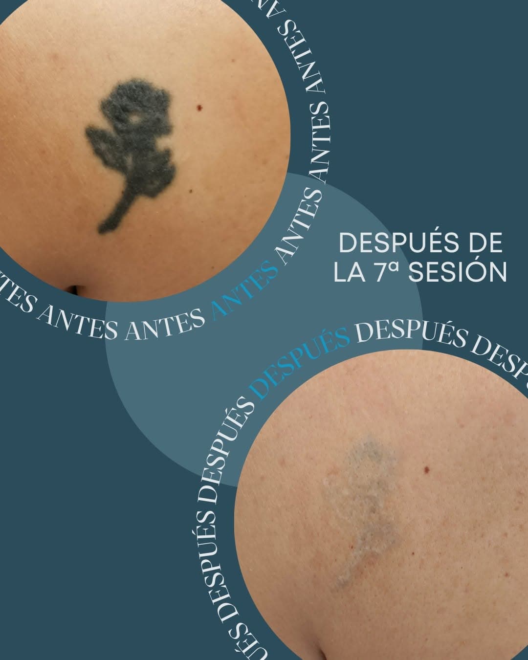 Di adiós a esta rosa en la espalda 👋🏻🌹 
Somos capaces de eliminar tatuajes con relieves por cicatriz producidos por el daño que ha hecho el tatuador como en este caso, a falta de una sesión para eliminar su tatuaje 🔥

Si tú también quieres borrar un tattoo del pasado, ¡te esperamos! ☎️

#NoMasTattoo #tatuajes #tattoo #GranCanaria #LasPalmas #eliminaciontatuajes #tattooremoval