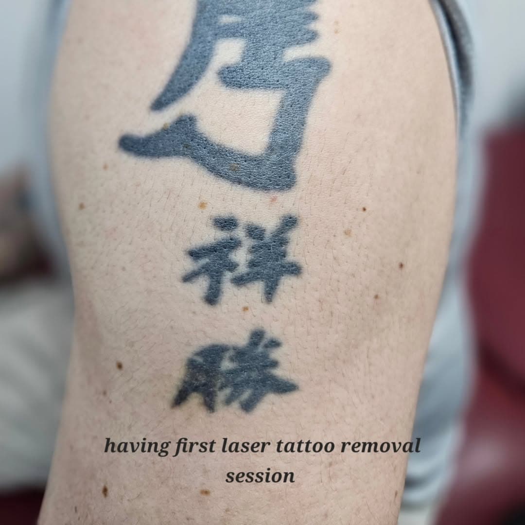 Having first laser tattoo removal session 
For more info please call the shop on 01992 711917 or dm me