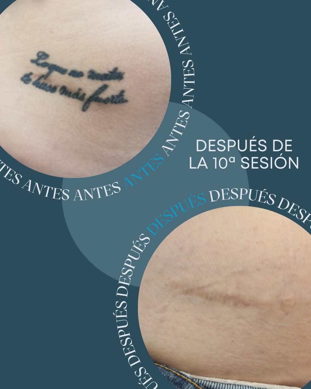 ¡Adiós al pasado! 👋🏻💨

Un tatuaje con trazo grueso puede parecer difícil de eliminar, pero nosotros demostramos que nada es imposible. Tras 10 sesiones de precisión láser, la tinta desapareció por completo dejando la piel como nueva 🆕

#NoMasTattoo #tatuajes #tattoo #GranCanaria #LasPalmas #eliminaciontatuajes #tattooremoval