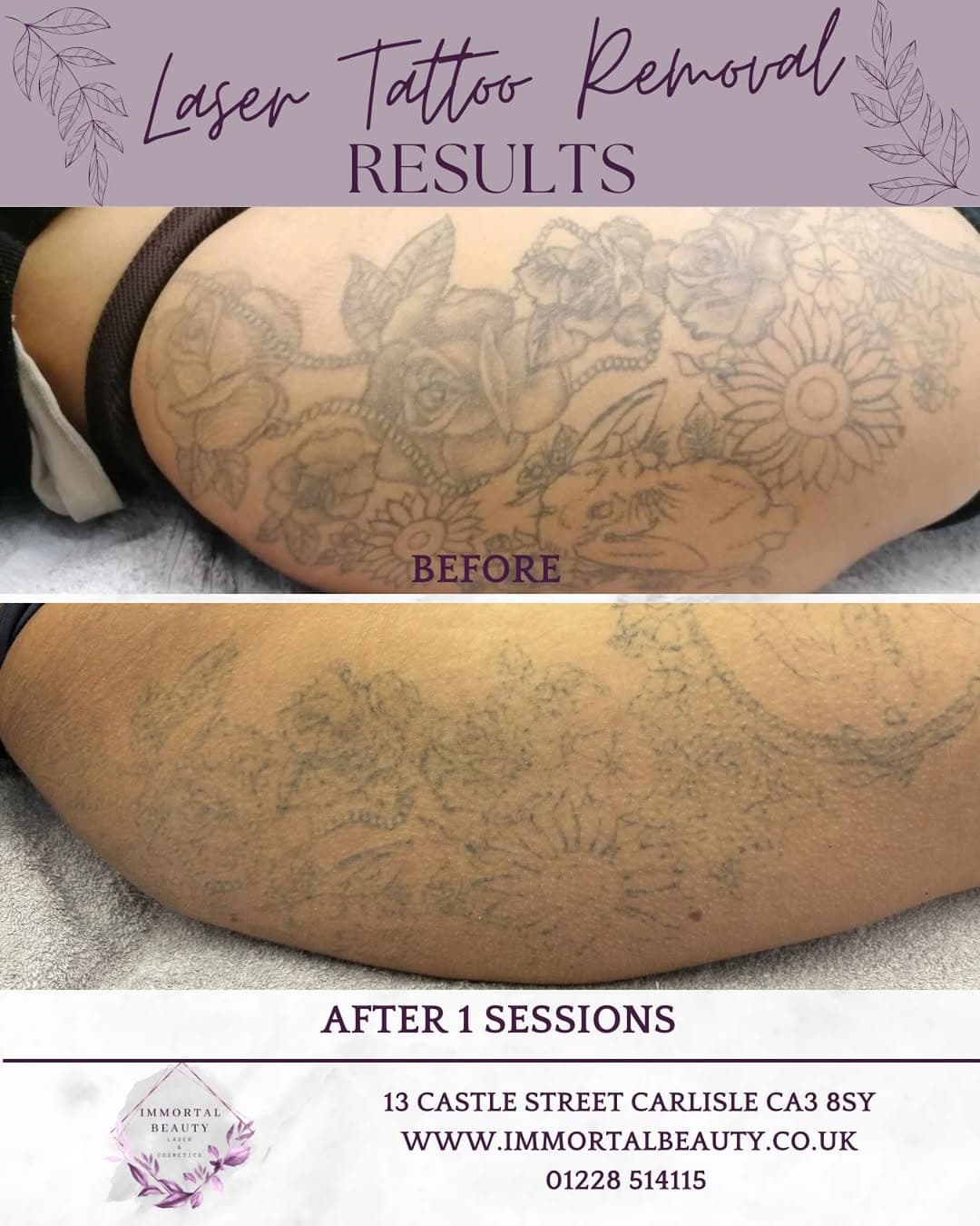 Laser tattoo removal by @immortalbeautycarlisle  For the full laser tattoo removal information please see megans website https://immortalbeauty.co.uk/lasertattooremoval/

Or to book a consultation please book through the link http://phore.st/wVCk3