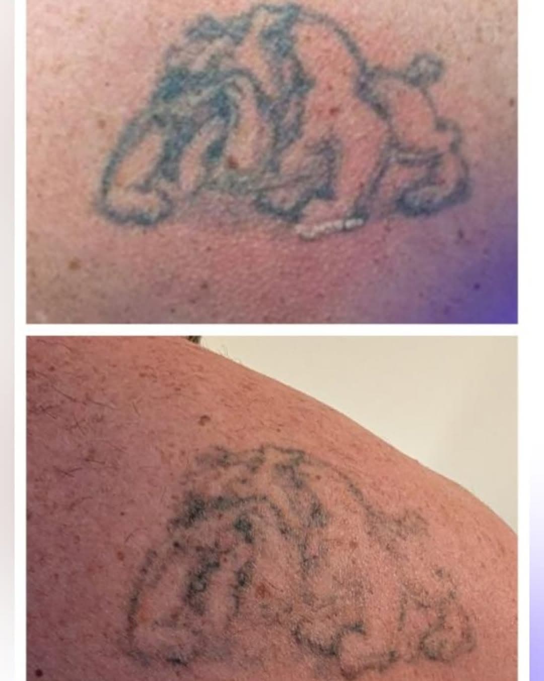 @evanescentlaser doing wonders on these older tattoos! Less than 3 weeks into the healing and the tattoo will fade more week by week!
Lock in the introductory offers as this week is the last week you can 💪